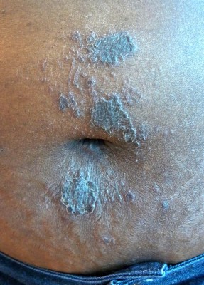 Liquen-Plano-Dermatologia-e-Saude