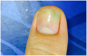 Manchas brancas nas unha