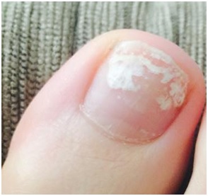 Manchas brancas nas unha