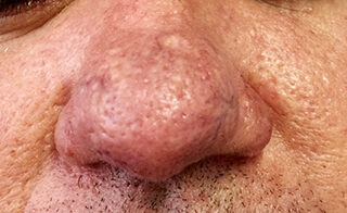 Rinfoma-Dermatologia-e-saude-21-08-2015