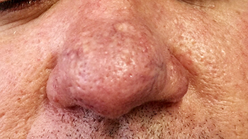 Rinfoma-Dermatologia-e-saude-21-08-2015