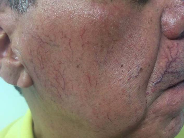 Telangiectasias - vasinhos visíveis