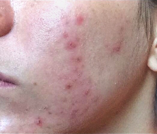 acne-na-vida-adulta-dermatologia-e-saude (1)