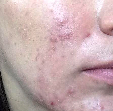acne-na-vida-adulta-dermatologia-e-saude (2)