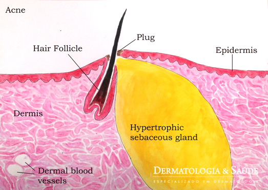 Acne em atividade, com glândula de tamanho aumentado, e formação de rolha (plug) em saída de folículo piloso