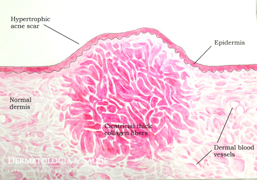 Cicatriz de acne elevada, pela grande formação de colágeno grosseiro durante a atividade da acne
