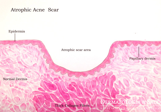 Cicatriz de acne deprimida