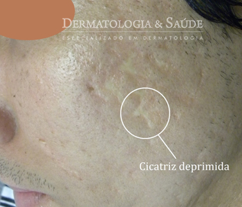 A acne frequentemente deixa cicatrizes de vários formatos, que podem ocorrer na face ou tronco