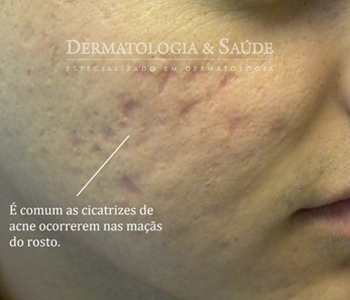 A maioria das cicatrizes de acne é deprimida (em forma de furo). Há vários tipos de tratamento para cicatrizes de acne