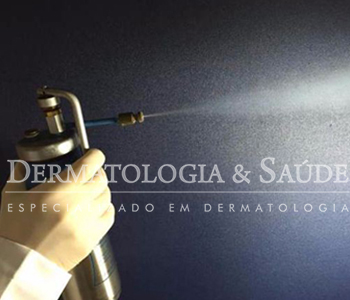 Na criocirurgia, congela-se a lesão a ser tratada com disparos de nitrogênio líquido