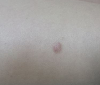 dermatofibroma-dermatologia-e-saude-02-350x300