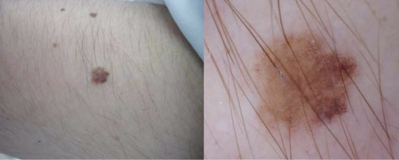 Sinal no antebraço analisado a olho nu (esquerda) e com dermatoscopia (direita)