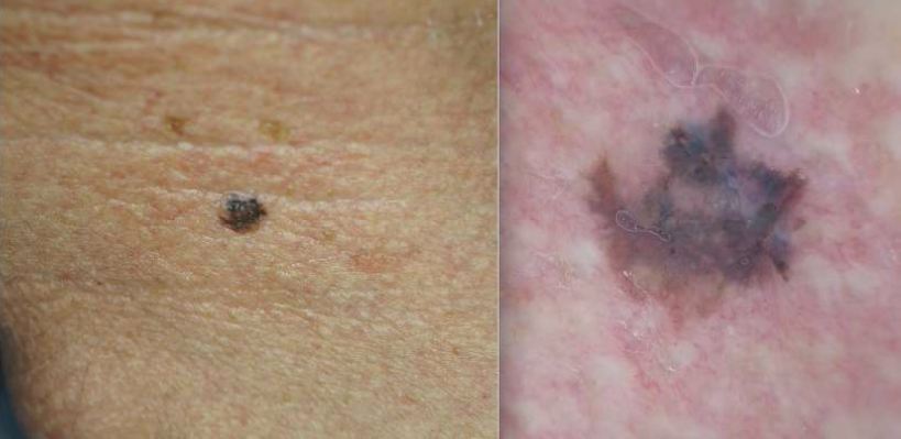 No lado esquerdo está um sinal no pescoço, enquanto na direita o mesmo sinal é analisado com dermatoscopia.