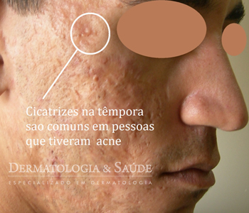 Em homens a acne costuma ser mais intensa e gerar cicatrizes mais grosseiras