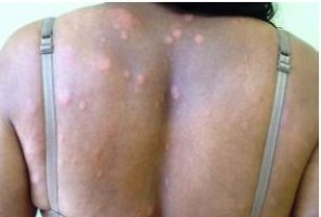 hanseniase multibacilar , manchas dormentes nas costas de paciente do sexo feminino