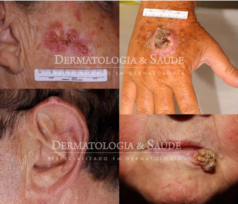 figura-carcinoma-espinocelular-orelha-boca-ferida-que-nao-cicatriza-cancer-de-pele-dermatologia-e-saude