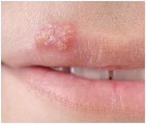 HSV 1 - Herpes oral