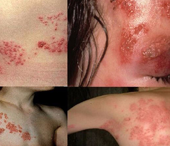 herpes zoster