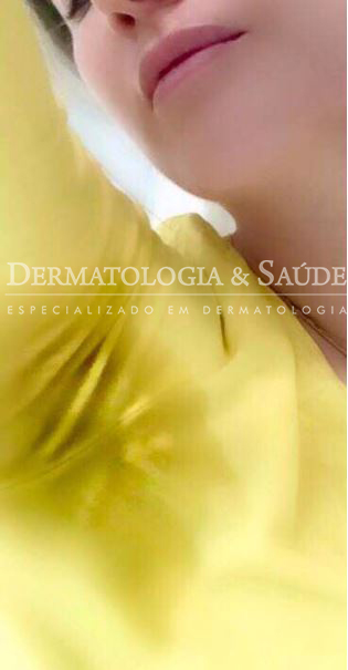 A cirurgia de sucção curetagem das glândulas axilares é um procedimento simples, porém, poucas pessoas sabem desta opção de tratamento para o suor excessivo nas axilas