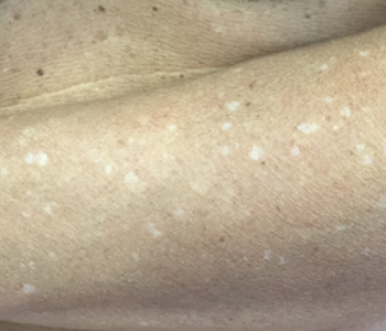 Leucodermias solares