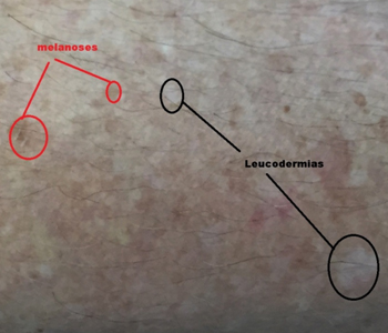 Leucodermias solares