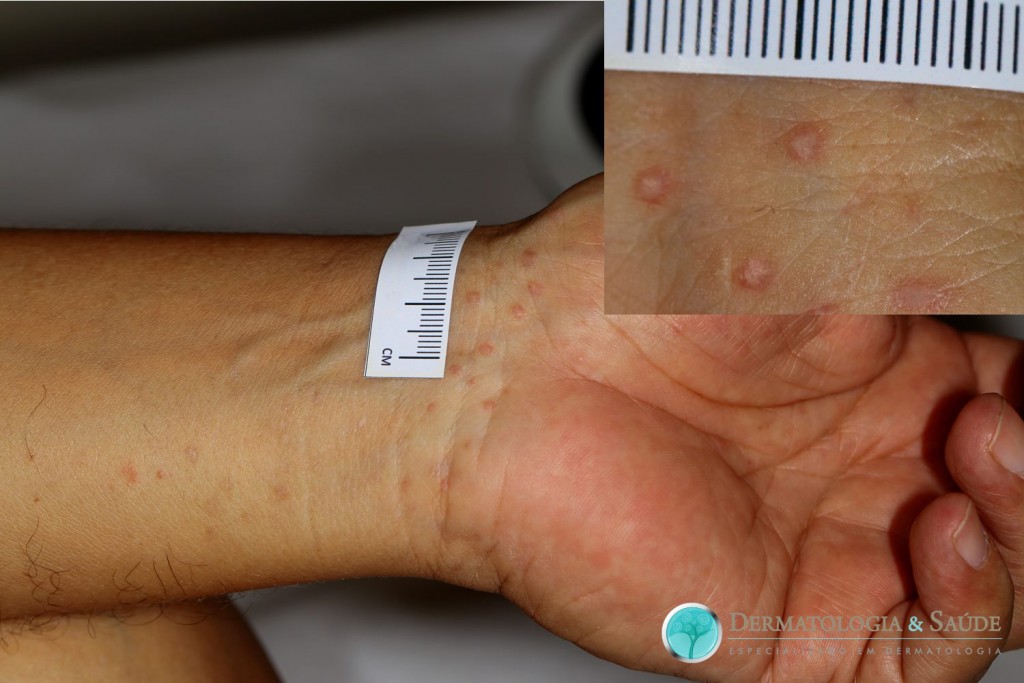 liquen-plano-dermatologia-e-saude-medicos-dermatologistas