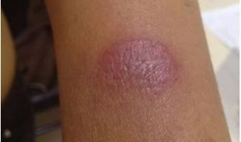 hanseniase paucibacilar , mancha dormente no braço de paciente do sexo feminino