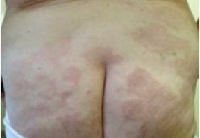 hanseniase multibacilar , manchas dormentes na região glútea de paciente do sexo feminino