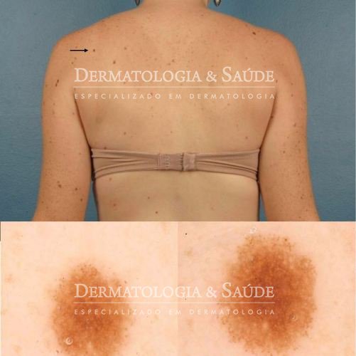 mapeamento-corporal-e-dermatoscopia-digital-dermatologia-e-saude-02