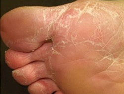 Tipo vésico-bolhosa da micose dos pés