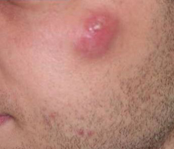 Cisto infectado em bochecha esquerda