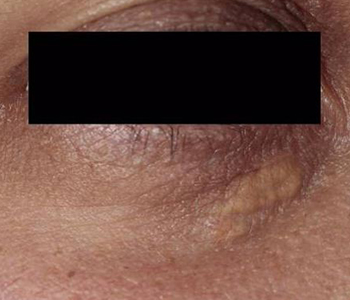 Xantelasma