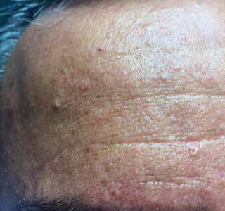 hiperplasias sebáceas