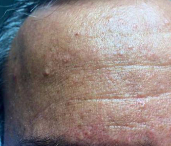 hiperplasias sebáceas