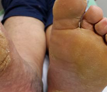 pes-ressecados-como-cuidar-dermatologia-e-saude-350x300-1