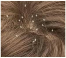 As lêndeas são os ovos do piolho