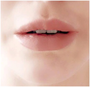 Preenchimento dos lábios