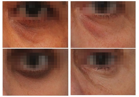 Exemplos de olheiras que se beneficiam com o preenchimento 