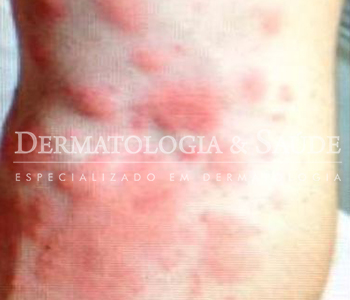 Atopia (asma na pele)