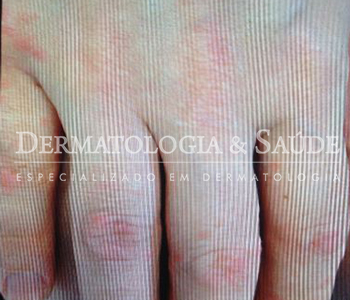 prurido-dermatologia-e-saude-350x300-9