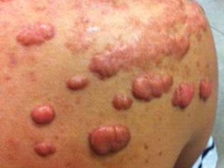 Queloide no ombro de adolescente, causado por acne