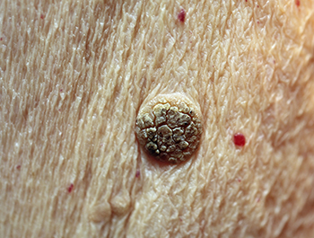 queratose-ceratose-seborreica-02-350x300