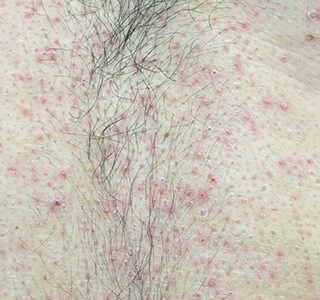 Queratose Pilar no tronco