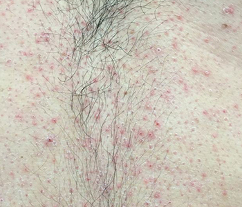 Queratose Pilar no tronco