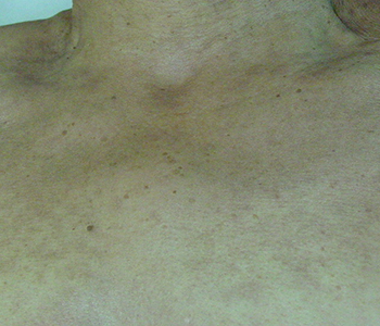 rejuvenescimento-do-colo-dermatologia-e-saude-01-350x300