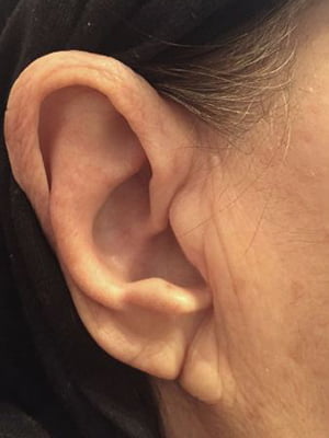 Flacidez do lobo da orelha
