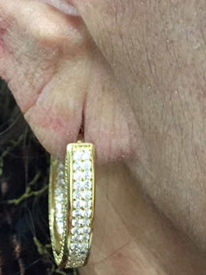 Flacidez do lobo da orelha