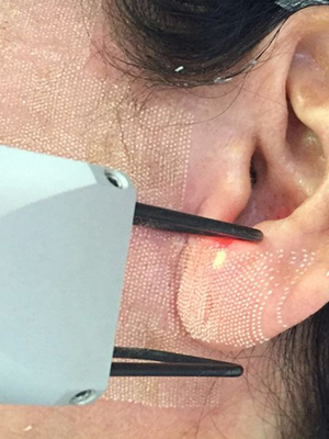 Laser no lobo da orelha