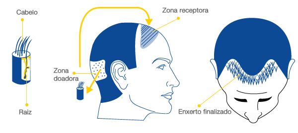 restauracao-capilar-transplante-capilar-natural-dermatologia-e-saude-350x300
