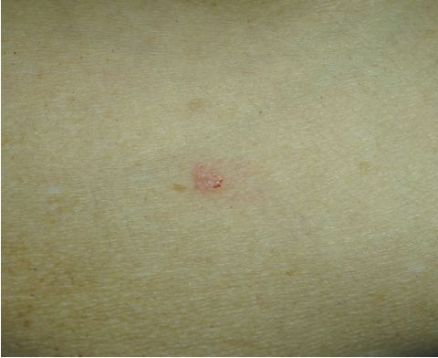 Carcinoma epidermoide